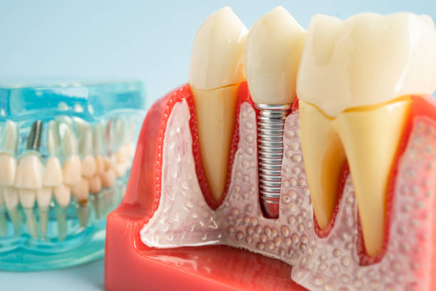 Best Wisdom Tooth Removal  in Middletown, DE